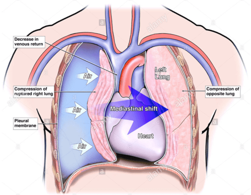 Schéma explicatif du pneumothorax sous tension