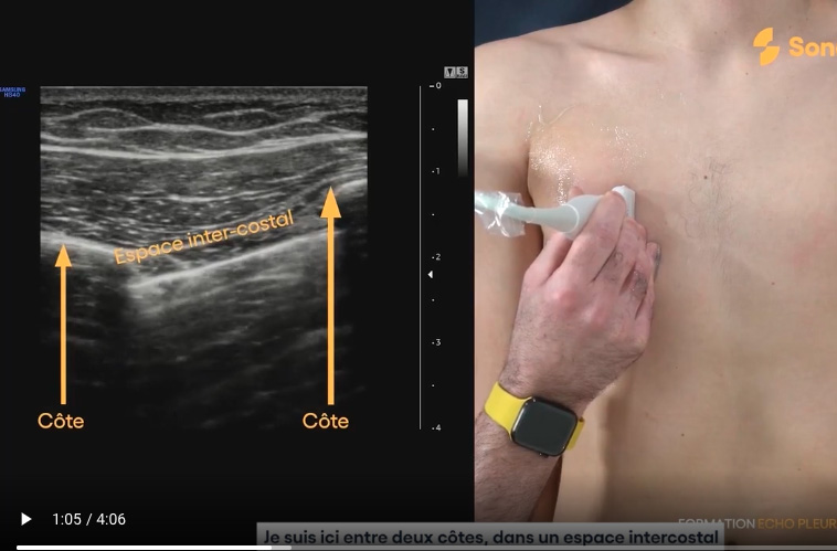 Echographie à la recherche d'un pneumothorax, identification de l'espace intercostal
